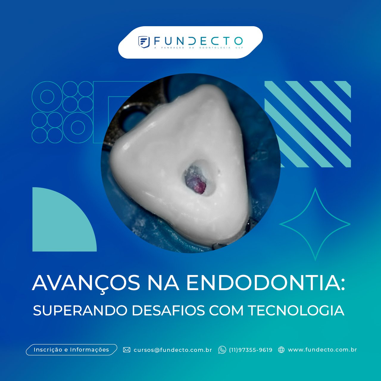 Avanços na Endodontia